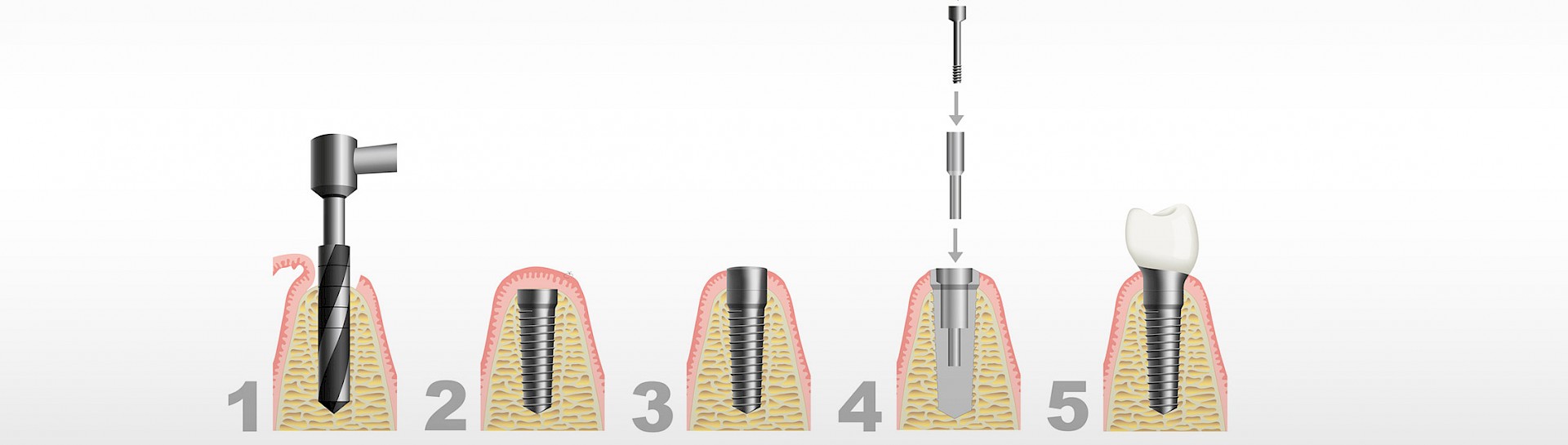 Zahnarztpraxis Wostratzky Implantate